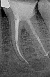 Root Canals Why Does Tooth Pain Occur What is Happening In The Root