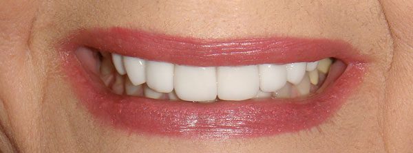 “After” closeup of a smile that was cosmetically restored by Dr. Klym using veneers