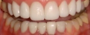 Closeup of smile after veneers smile makeover