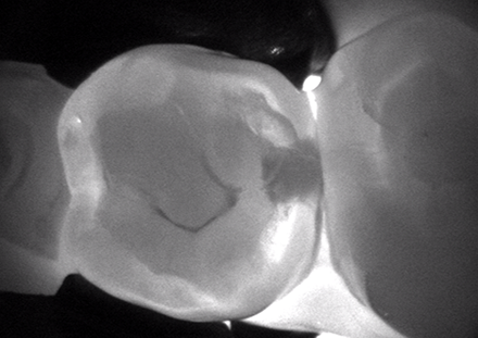 an x-ray of a tooth from the top