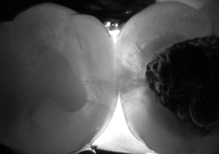 an X-ray of a tooth with a dark spot