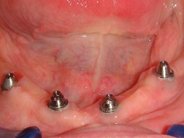 Four dental implants with abutments in Teeth in a Day case