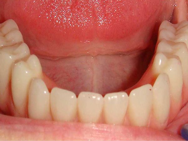 Teeth in a day case with attached denture