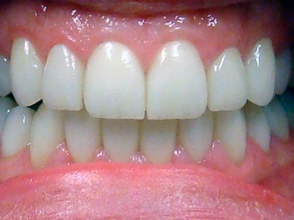 An attractive bright smile that’s been restored by Dr. Klym at Northwood Dental.