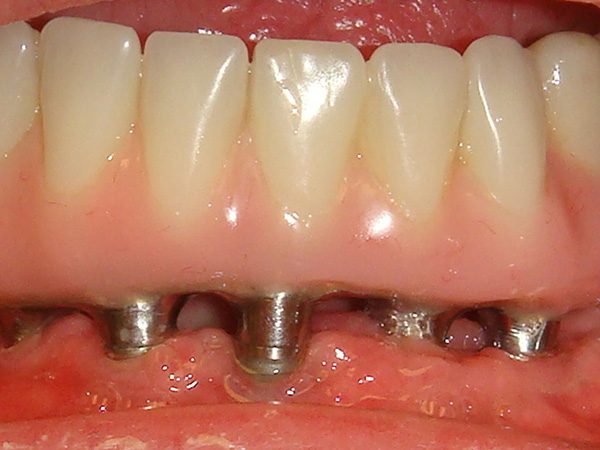 Closeup of a patient’s lower arch with the implant denture about to be placed