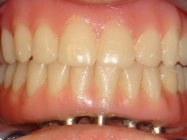 “After” closeup of a smile showing the lower implant supported denture about to be placed