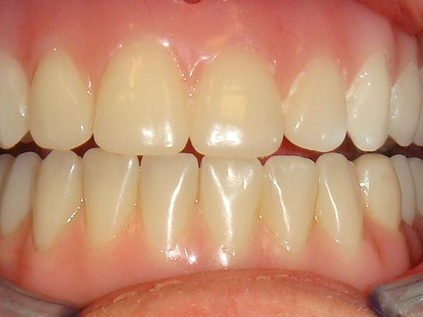 “After” closeup of a smile that was cosmetically restored by Dr. Klym using implant-supported dentures.