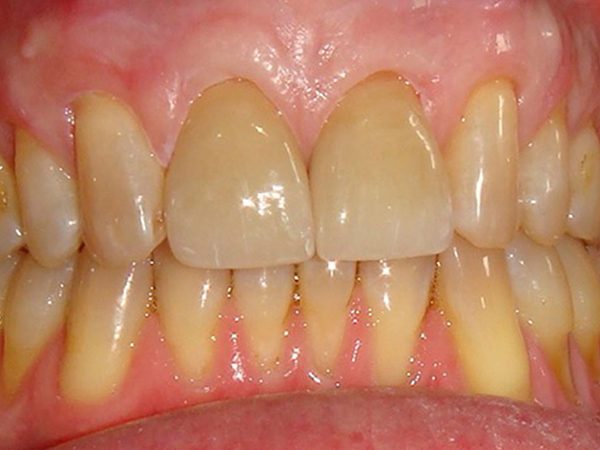 After picture of a patient whose smile was cosmetically restored by Dr. Klym at Northwood Dental.