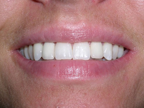 “After” image of a man’s smile that was cosmetically restored by Dr. Klym using dental implants and veneers.