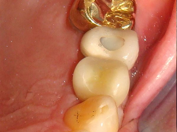 The attractive dental implant of a Northwoods Dental patient.