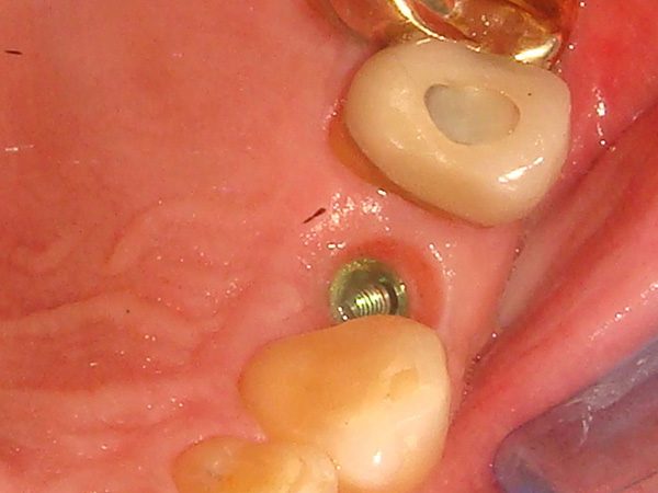 dental implant post in teeth
