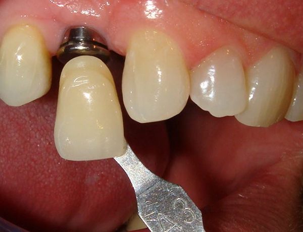 A dental implant that’s about to be attached to an implant fixture inside a patient’s mouth.