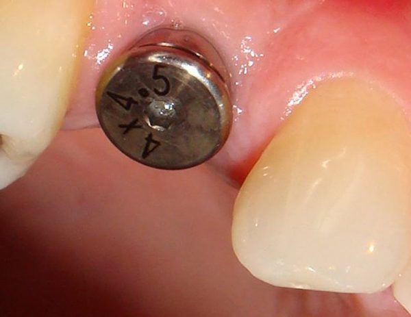 An implant fixture that has been surgically placed by Dr. Klym which is ready to be completed with the placement of a crown.