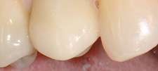 Closeup of a dental implant that was placed by Dr. Klym.