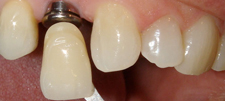 A dental crown about to be placed on a dental implant