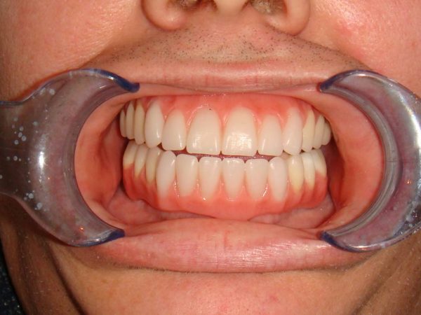 Closeup of temporary dentures worn by a patient who would be getting implant-support full-mouth reconstruction.