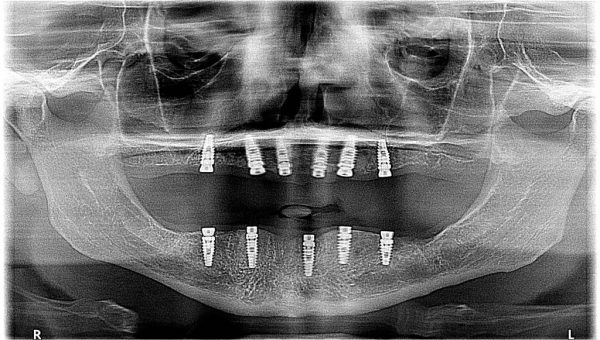 X-ray of ten dental implant fixtures that have been surgically placed in a patients jaws as part of a full-mouth reconstruction.