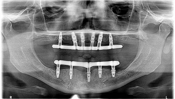 X-ray of a smile with ten dental implants placed in preparation for full-mouth reconstruction.
