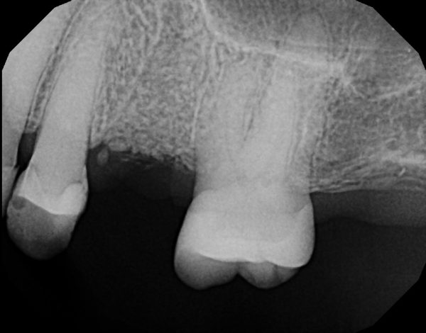 X-ray image of the jawbone and teeth surrounding a missing tooth.