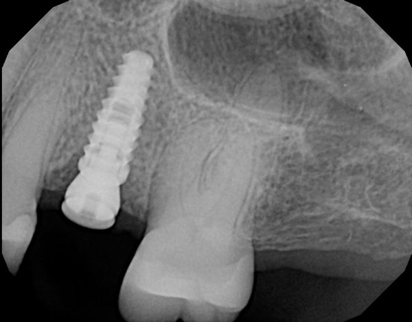 X-ray image of a dental implant fixture.