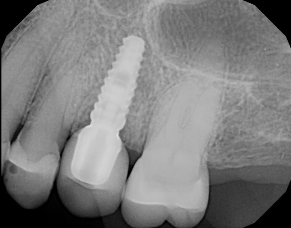 X-ray image of a dental implant fixture and crown restoration