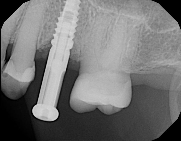 X-ray showing the placement of an implant