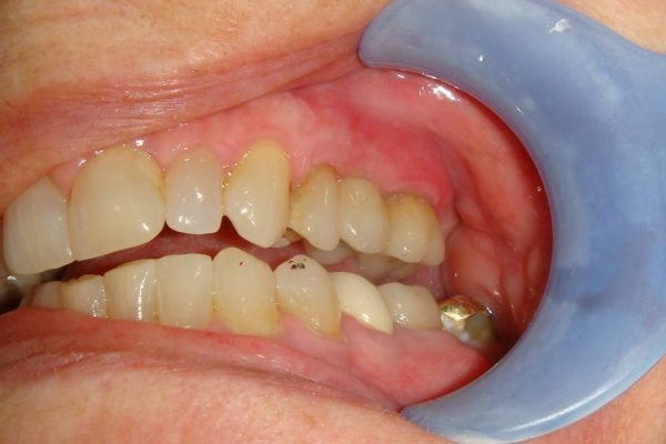 “Before” closeup of a smile that was later restored by Dr. Klym using dental implants.