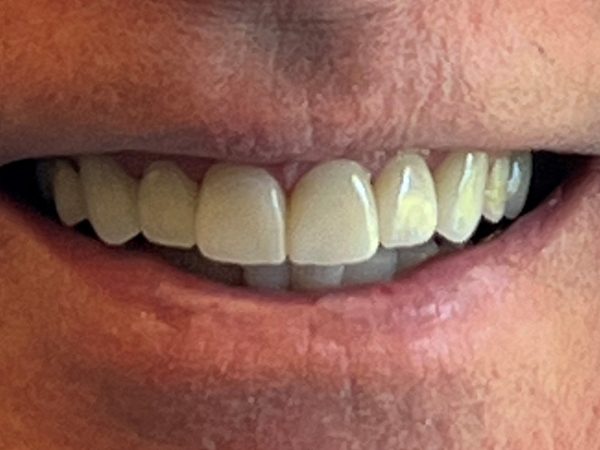 after dental restoration