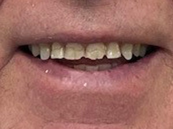 before dental restoration